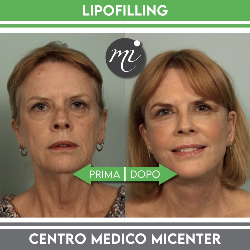 lipofilling del viso prima e dopo