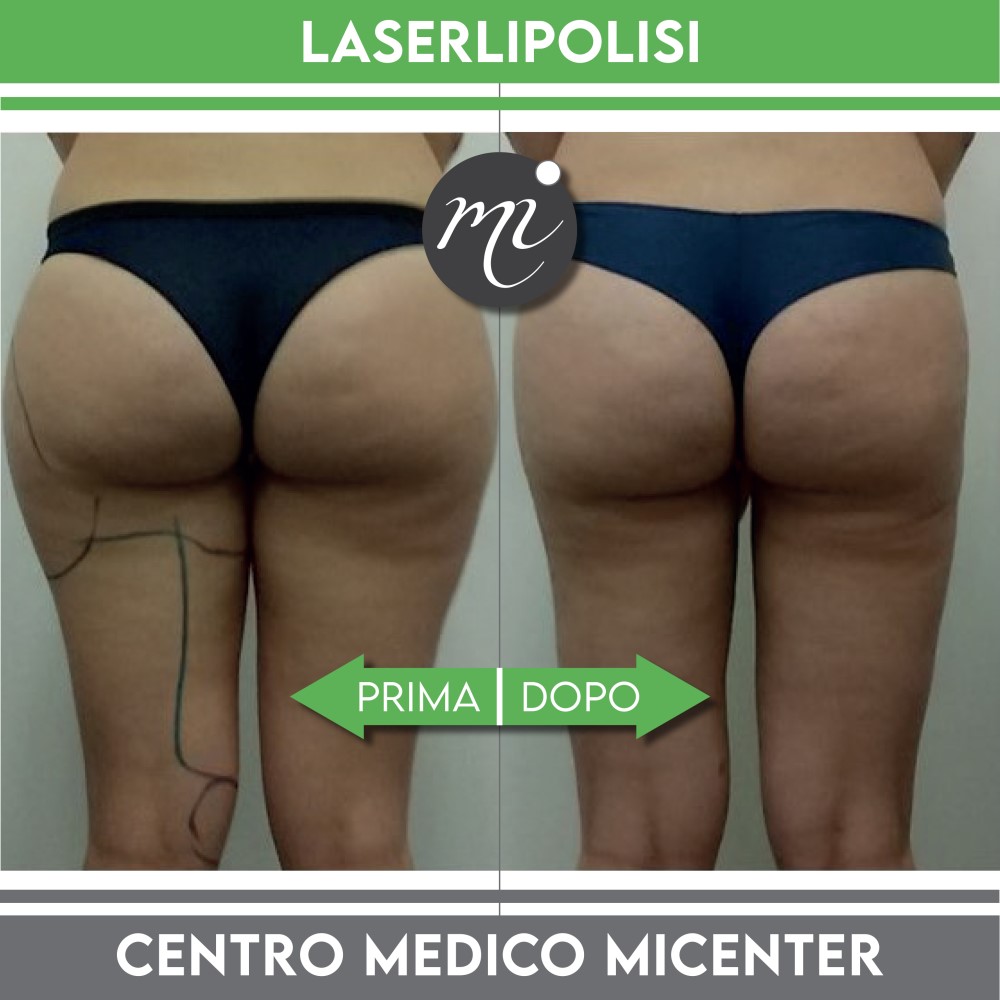 Prima e dopo Liposuzione