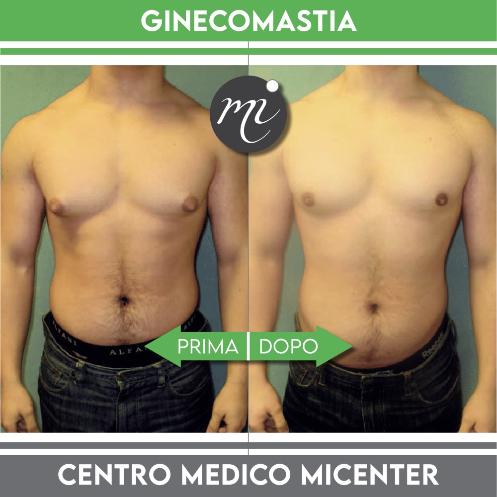 Prima e dopo Ginecomastia