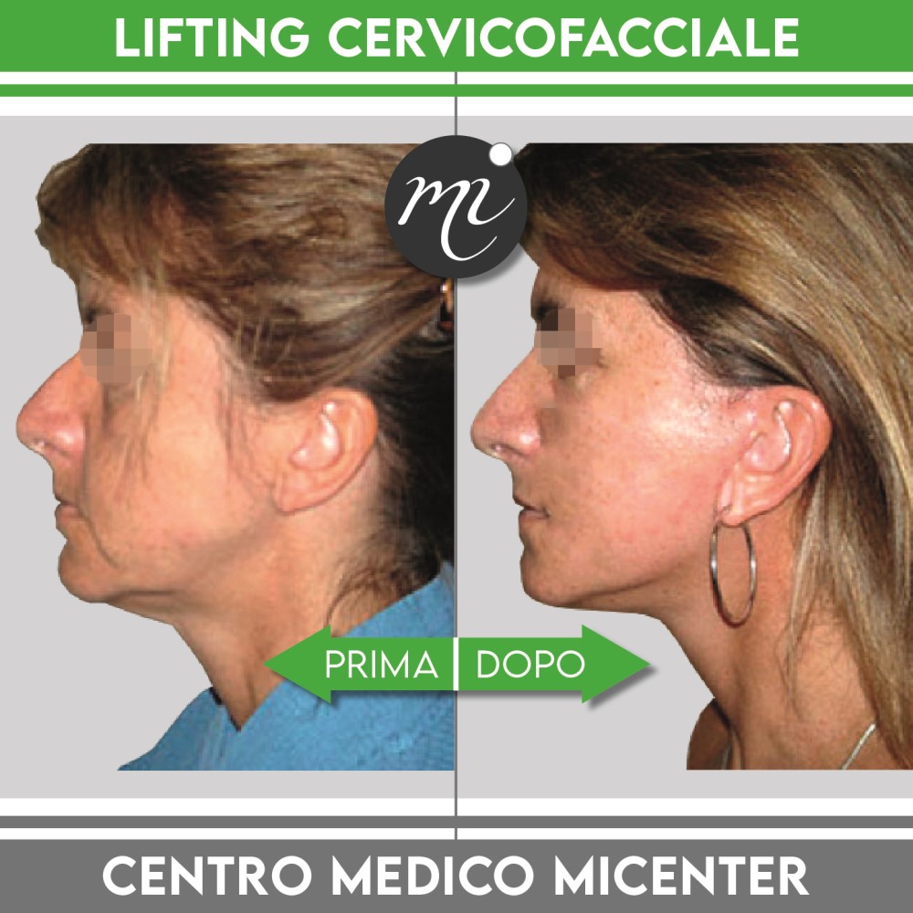 lifting cervicofacciale prima e dopo