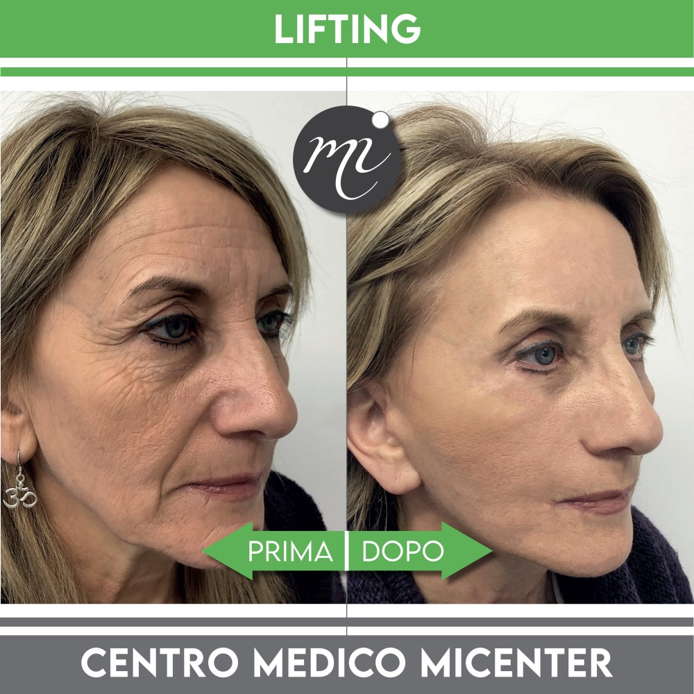 lifting cervicofacciale prima e dopo