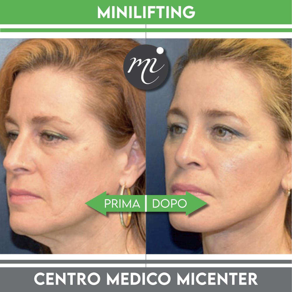Mini lifting prima e dopo