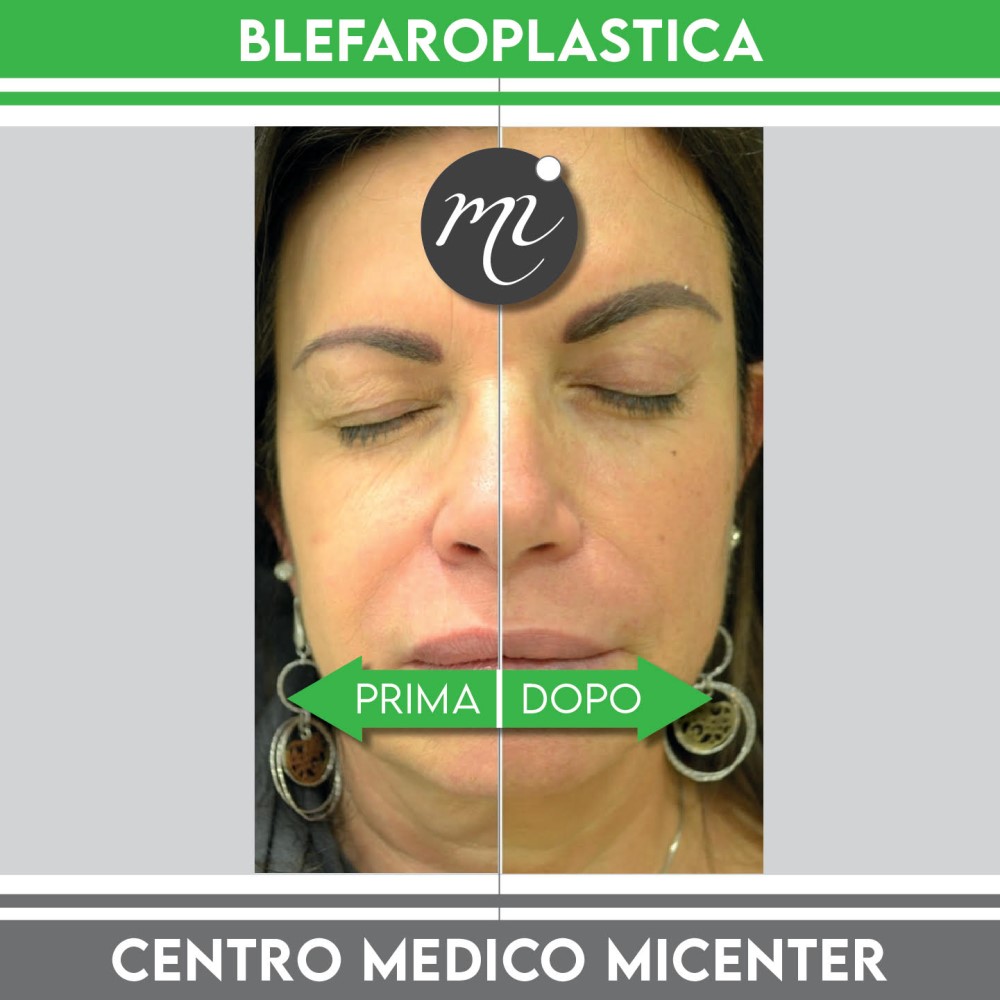 prima dopo Blefaroplastica