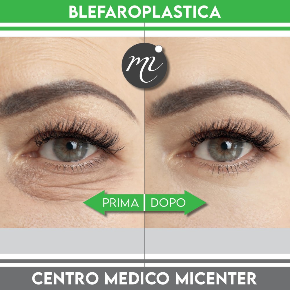 prima dopo Blefaroplastica