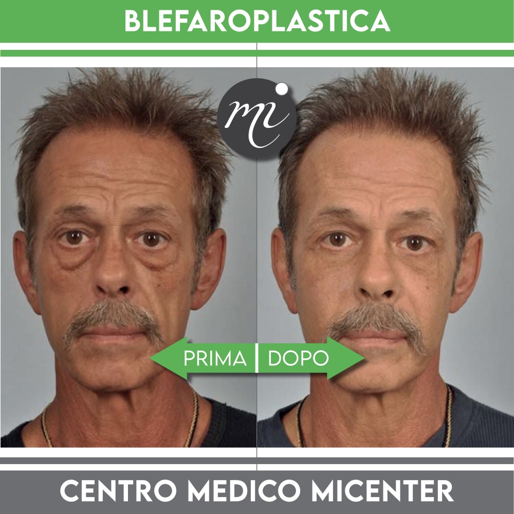 prima dopo Blefaroplastica