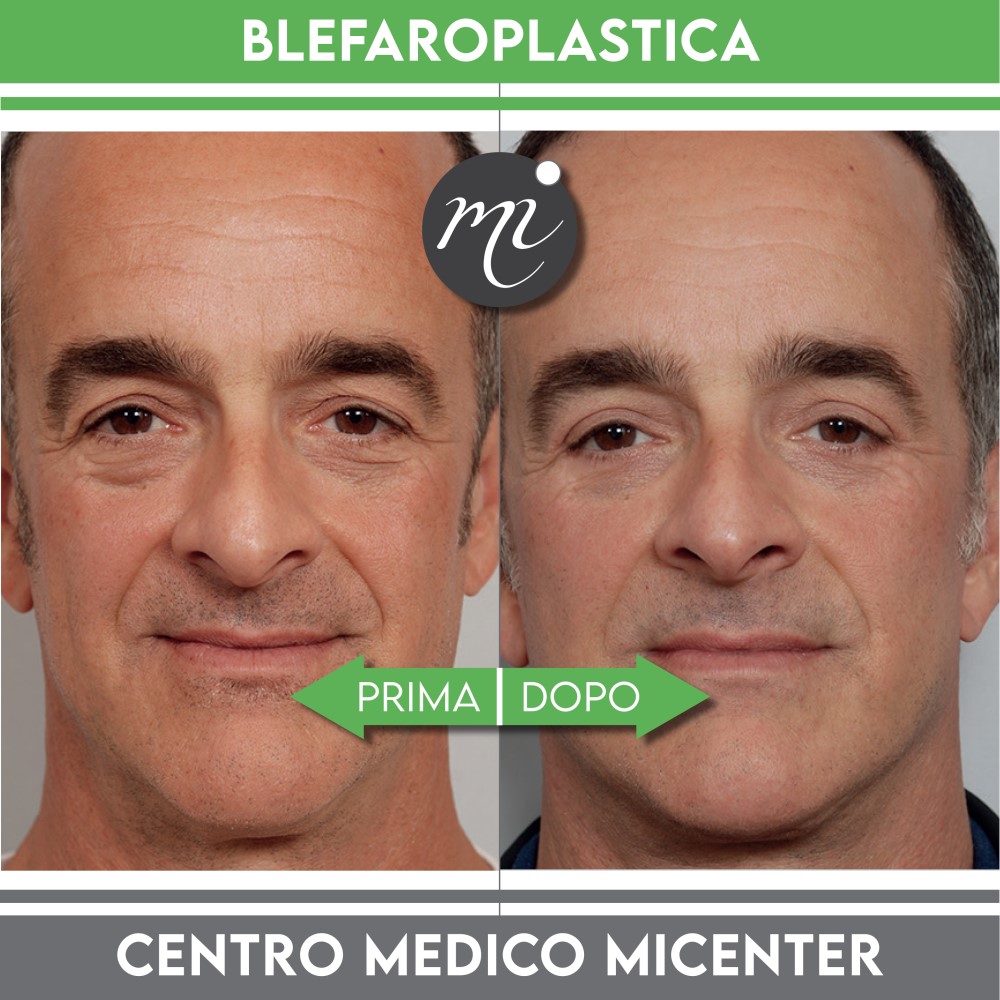 prima dopo Blefaroplastica