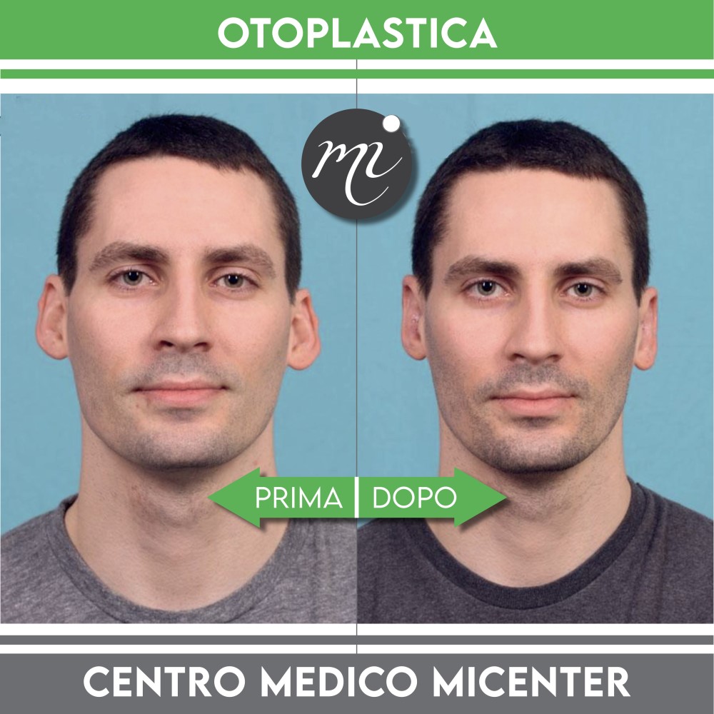 Otoplastica prima e dopo