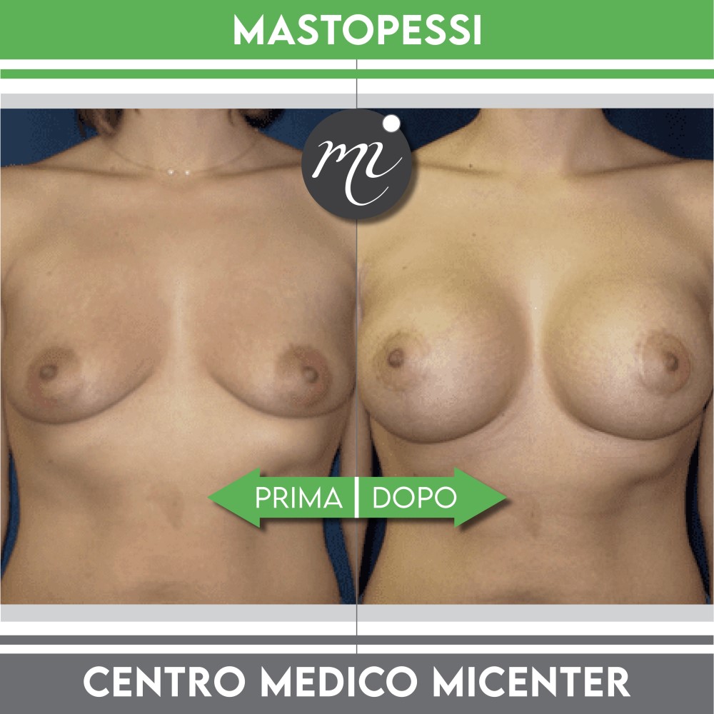 Prima e dopo mastopessi