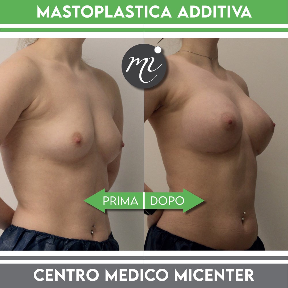 mastoplastica additiva prima e dopo