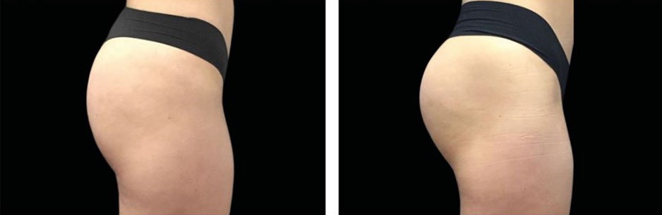 Risultati Emsculpt 1
