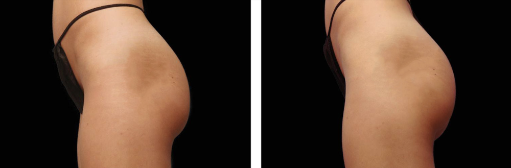 Risultati Emsculpt 2