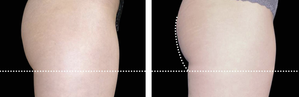 Risultati Emsculpt 3