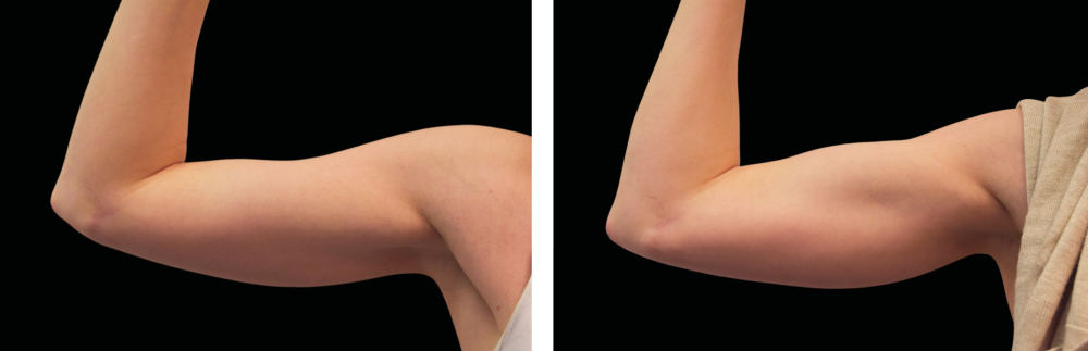 Risultati Emsculpt 8