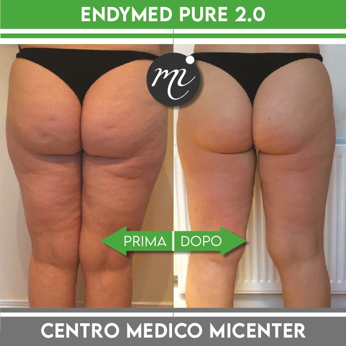 Risultati endymed cellulite micenter 1