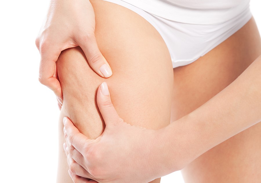 cellulite